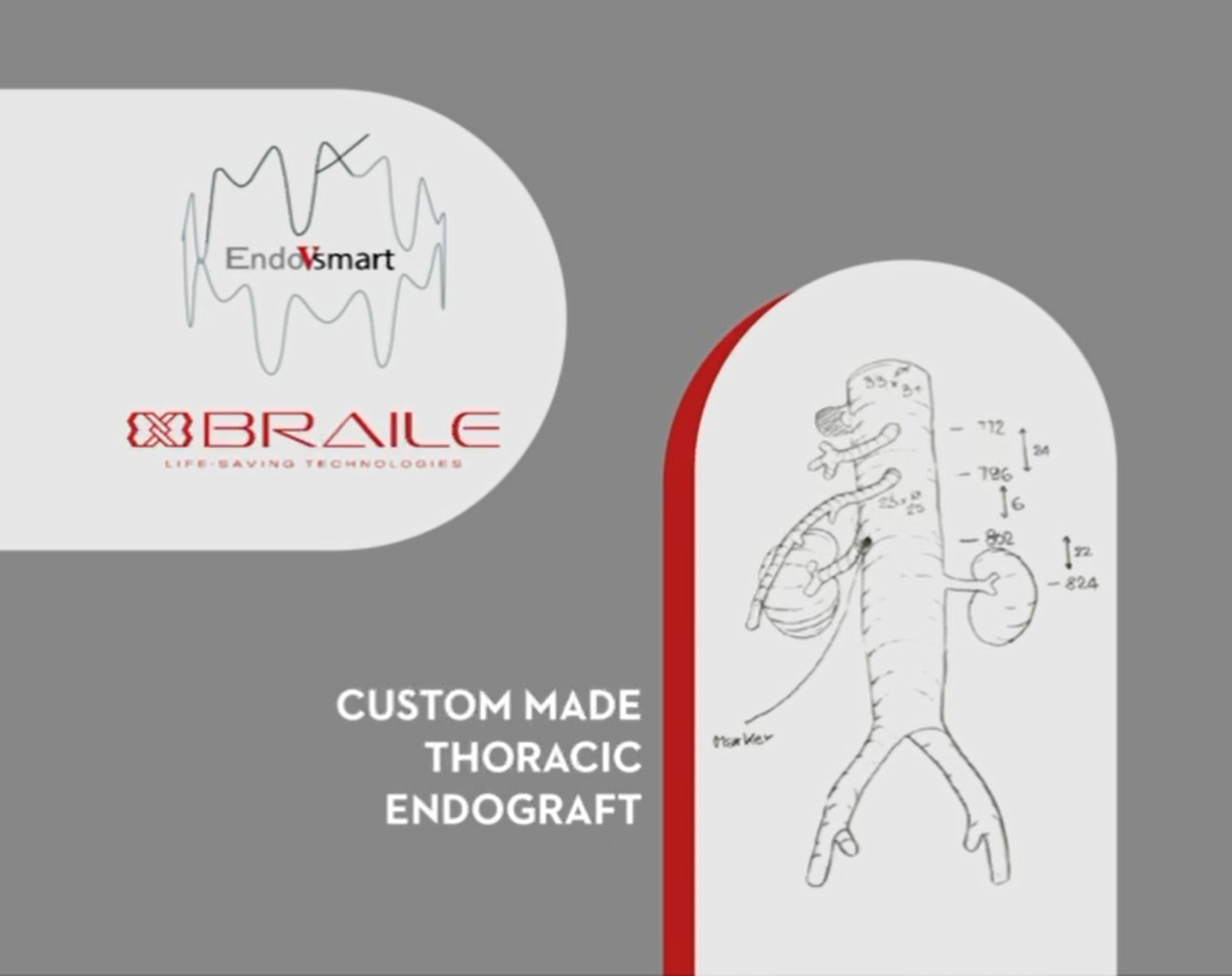 Custom Made Thoracic Endograft Case Study Thumbnail